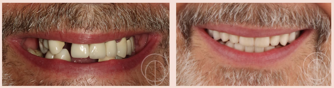 Dental implant patient 1: before treatment