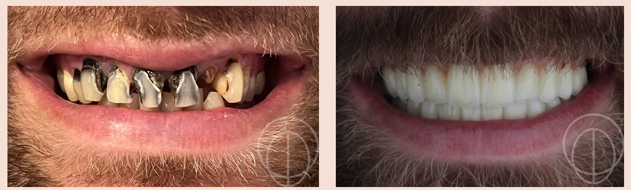 Dental implant patient 2: before treatment