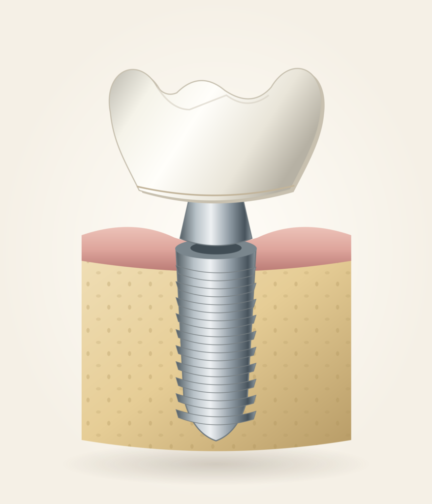 Shaded implant model showing the crown, abutment, and implant within supporting bone