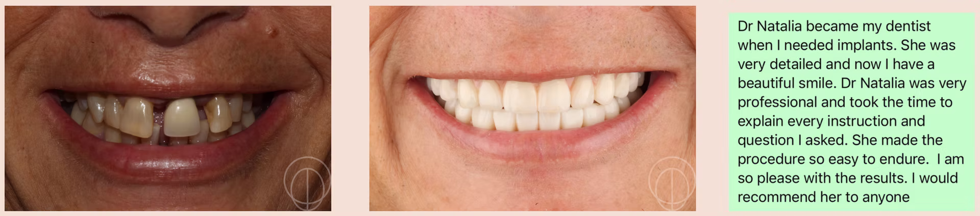 Patient example 1: before restorative dental treatment